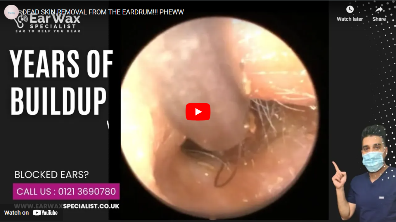 Earwax Removal YouTube Video on Dead Skin Removal from Eardrum
