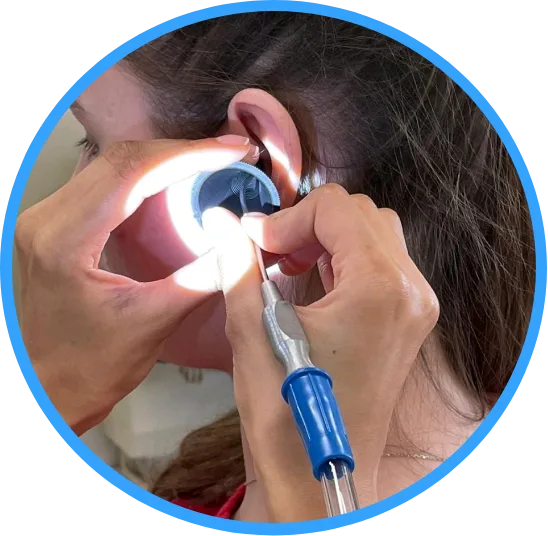 Close-up of ear with microsuction tool for safe earwax removal.