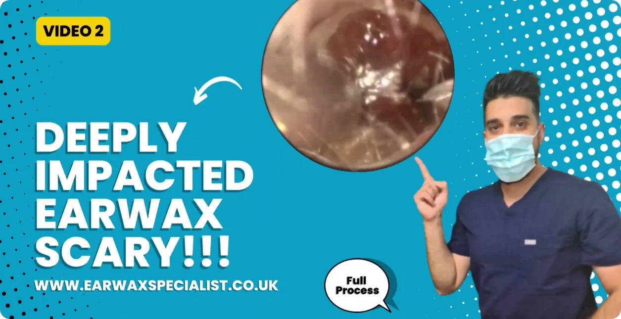 YouTube Video on Deeply impacted earwax by earwax specialist.