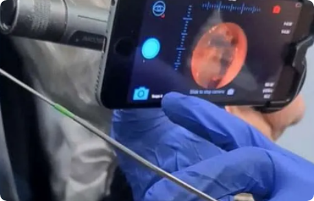 Close-up view of an ear inspection tool used by earwax specialists for safe removal procedures.